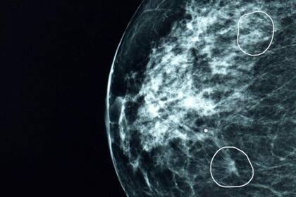 Herramienta MIA; BBC; BBC mundo; Cáncer ; Cáncer de mama; Sarah Kerruish; Kheiron Medical; Tumores; tumor; Inteligencia artificial; Sociedad; Salud;