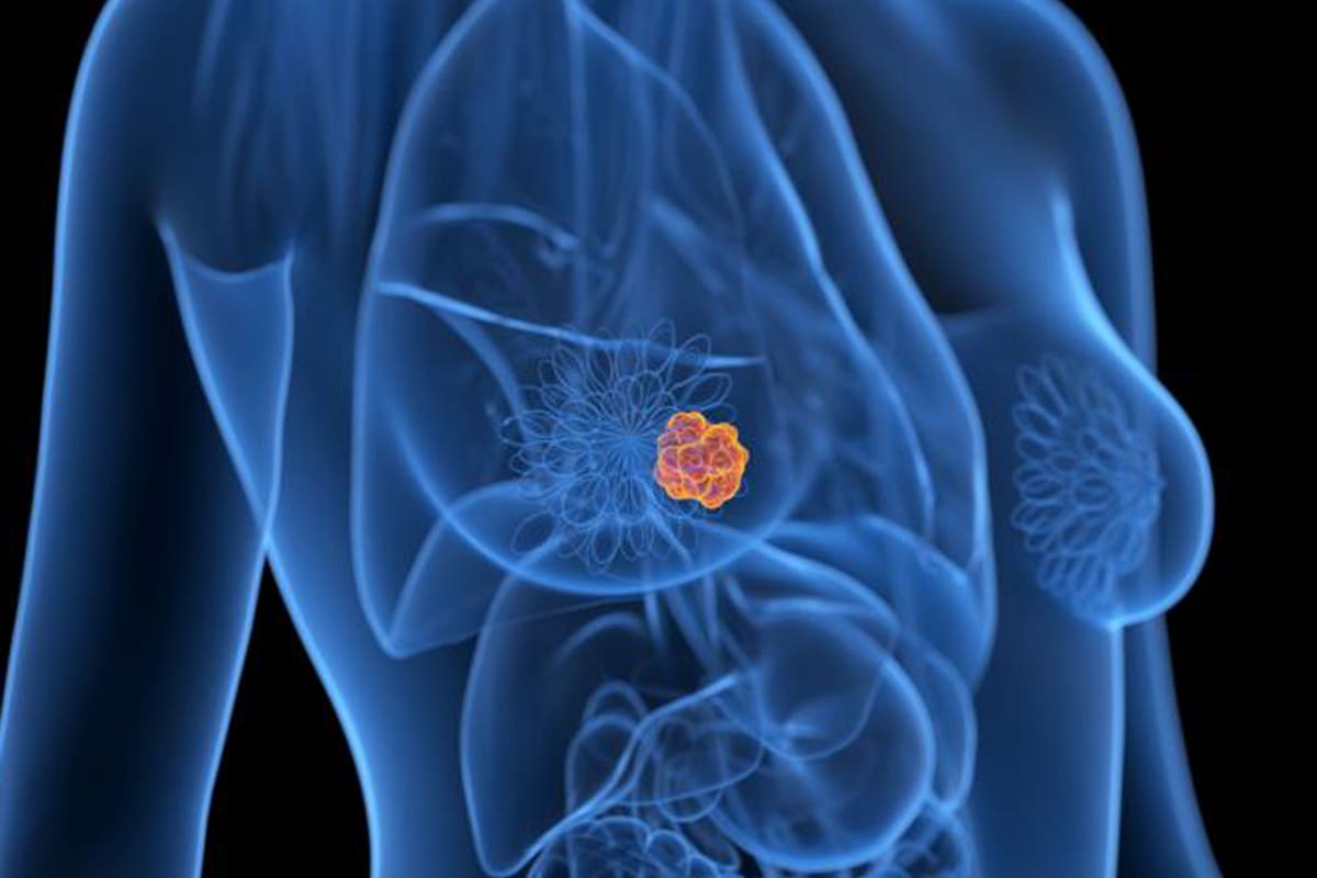Herramienta MIA; BBC; BBC mundo; Cáncer ; Cáncer de mama; Sarah Kerruish; Kheiron Medical; Tumores; tumor; Inteligencia artificial; Sociedad; Salud;