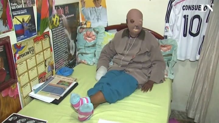 Una mujer colombiana atacada con ácido cancela su eutanasia tras hablar con el Papa