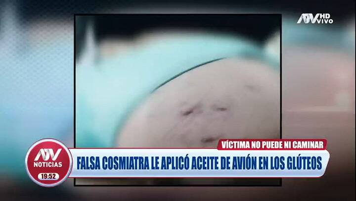 Una joven quería cambiar su apariencia y le inyectaron aceite de avión en lugar de ácido hialurónico