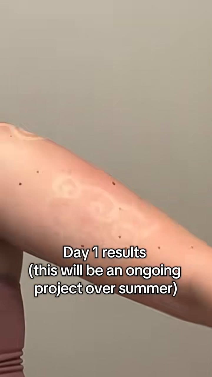 Dermatólogos advierten el peligro sobre la nueva moda de TikTok de tatuajes por quemaduras de la piel