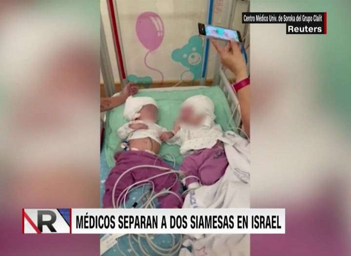 Separan a dos gemelas unidas por la cabeza tras una operación de 12 horas en Israel