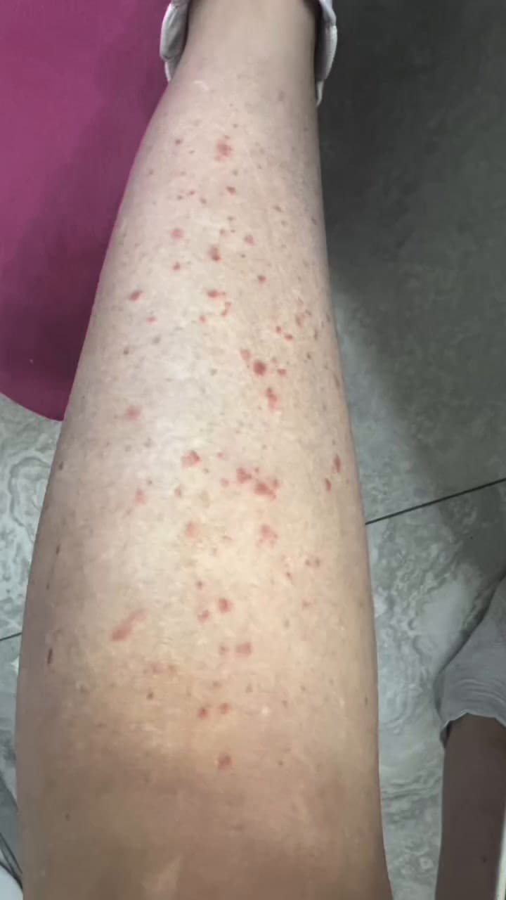 Miriam Lanzoni mostró las lesiones de su brote de psoriasis