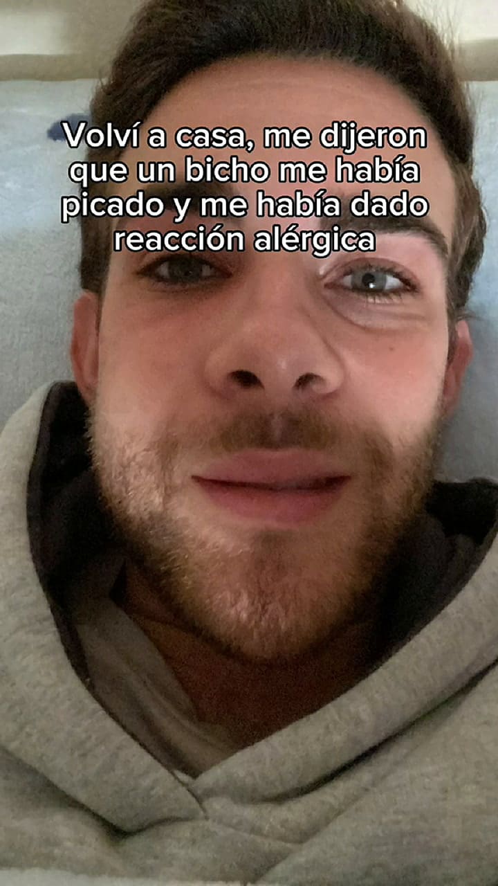 Un joven español se despertó con la cara hinchada y recibió un diagnóstico inesperado.