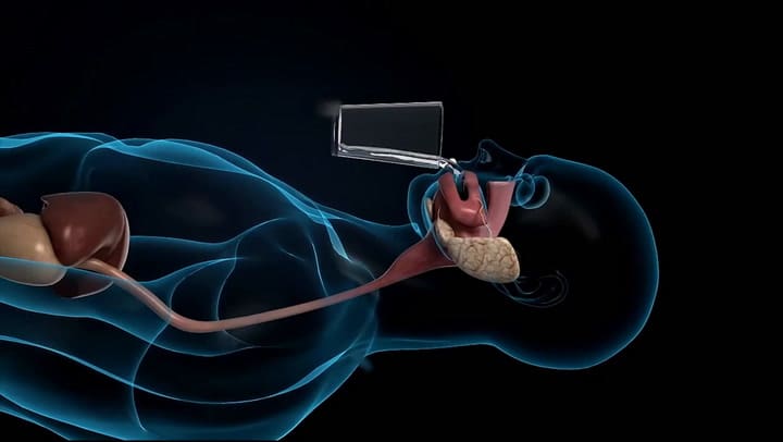 Navicam, el sistema para hacer endoscopías con una píldora