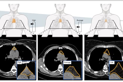 Ilustración de la salud del timo, es decir, un indicador de la funcionalidad del timo basado en imágenes y tres ejemplos representativos de individuos con salud del timo alta, media o baja. El lecho del timo está delineado en naranja
