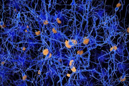 Ilustración de placas amiloides entre neuronas