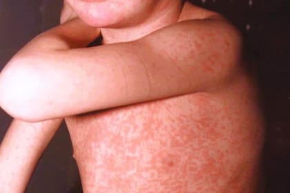 Imagen de la erupción (exantema) en la piel característica del sarampión