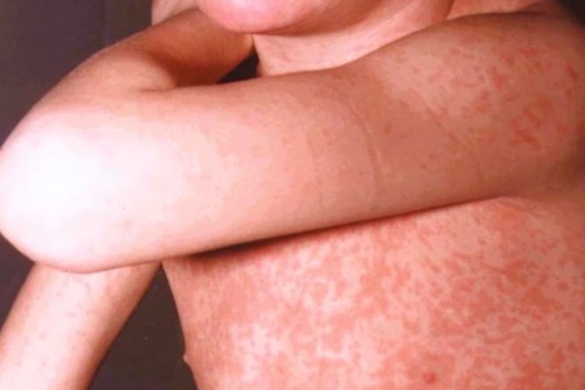 Imagen de la erupción (exantema) en la piel característica del sarampión