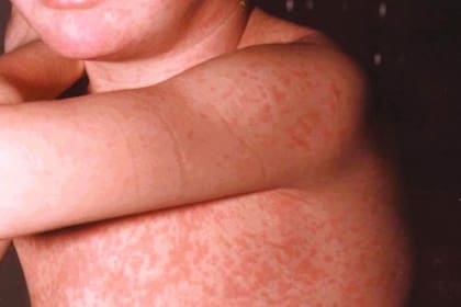 Imagen de la erupción (exantema) en la piel característica del sarampión