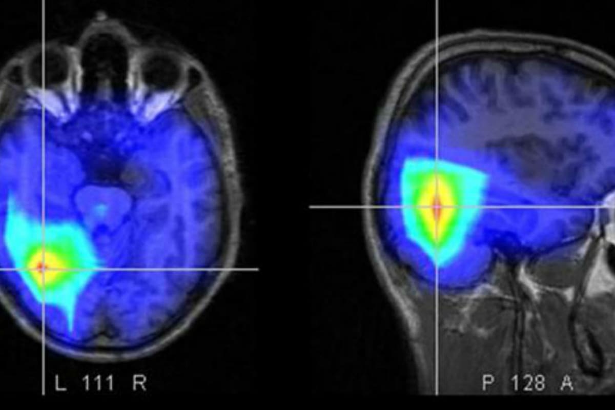 Imagen de un ACV en la computadora