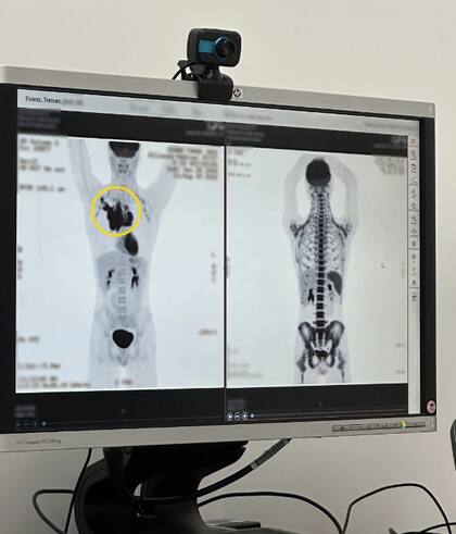 Imagen de una de los estudios que le practicaron al adolescente, antes de detectarle Linfoma de Hodgkin en etapa 2