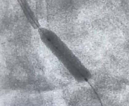 Imagen del stent bioabsorbible implantado durante la intervención. El dispositivo se degrada dentro del organismo en aproximadamente 12 meses y permite el crecimiento de la arteria tratada