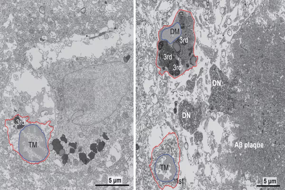 Imágenes de microscopio electrónico de la microglía del cerebro de una mujer sana de 92 años (izquierda) y de la microglía oscura de una paciente con Alzheimer de 91 años