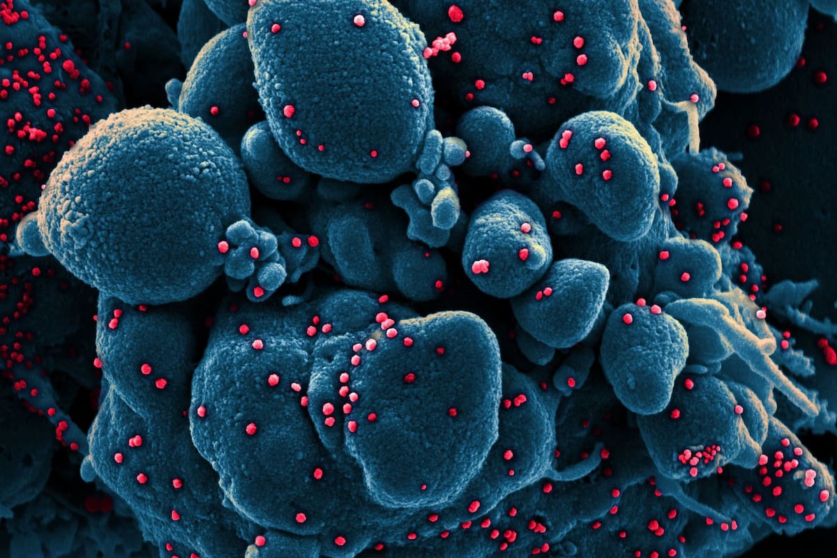 Imágenes de partículas dle coronavirus sobre una célula humana, tomadas con un microscopio electrónico y coloreadas en forma artificial