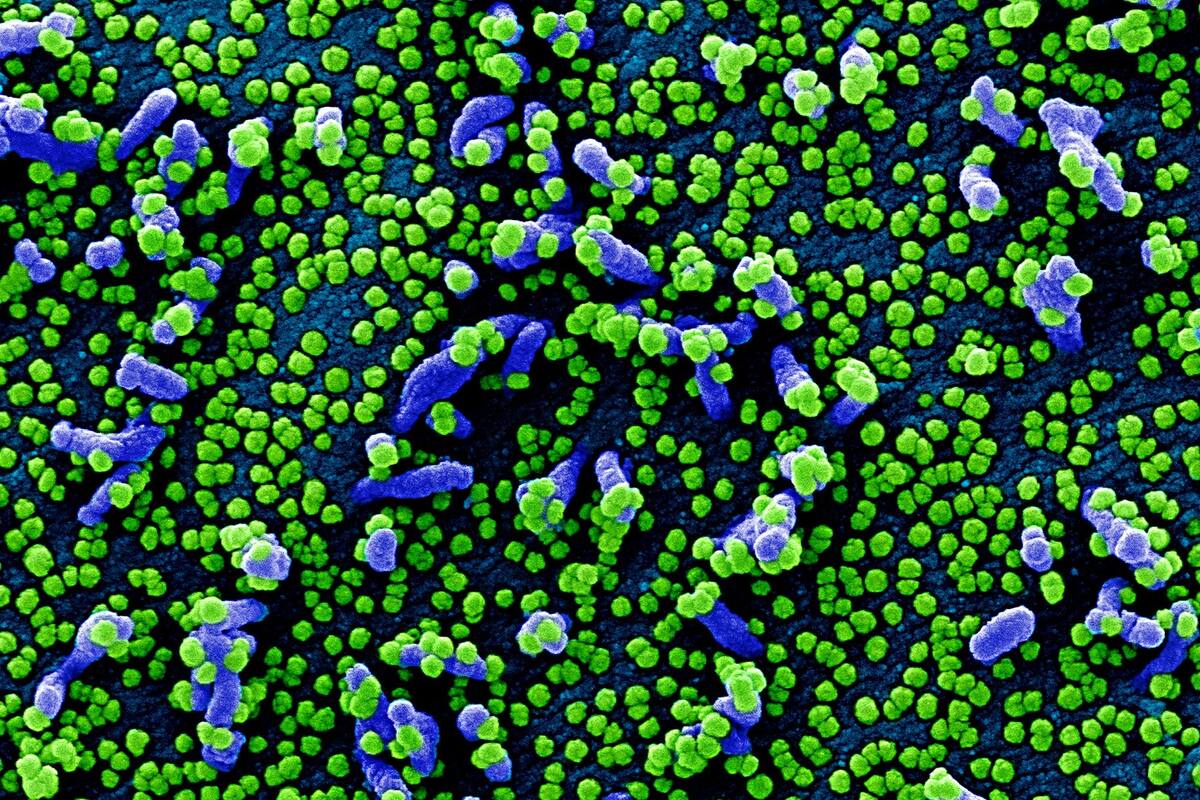 Imágenes de partículas dle coronavirus sobre una célula humana, tomadas con un microscopio electrónico y coloreadas en forma artificial