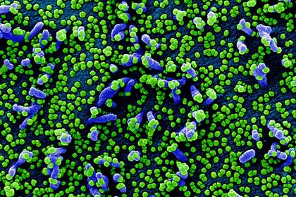 Imágenes de partículas dle coronavirus sobre una célula humana, tomadas con un microscopio electrónico y coloreadas en forma artificial