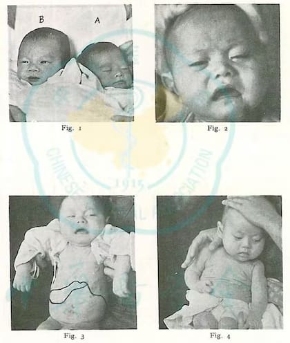 Imágenes de varios pacientes pediátricos de beriberi en Sanghai en una publicación médica de 1936 (Chinese Medical Journals)