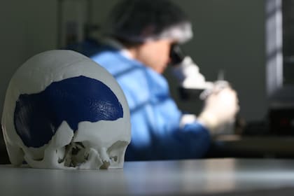 Imágenes del nuevo implante biosintético para trauma craneal o tumores cerebrales que permiten fabricados por la empresa local Raomed, de Córdoba