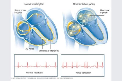 Infografía sobre un corazón con un ritmo cardíaco normal (izquierda) y otro con arritmia.