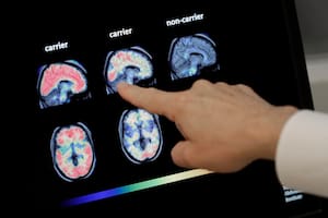 Un análisis de sangre alerta de los primeros síntomas diez años antes de tener Alzheimer