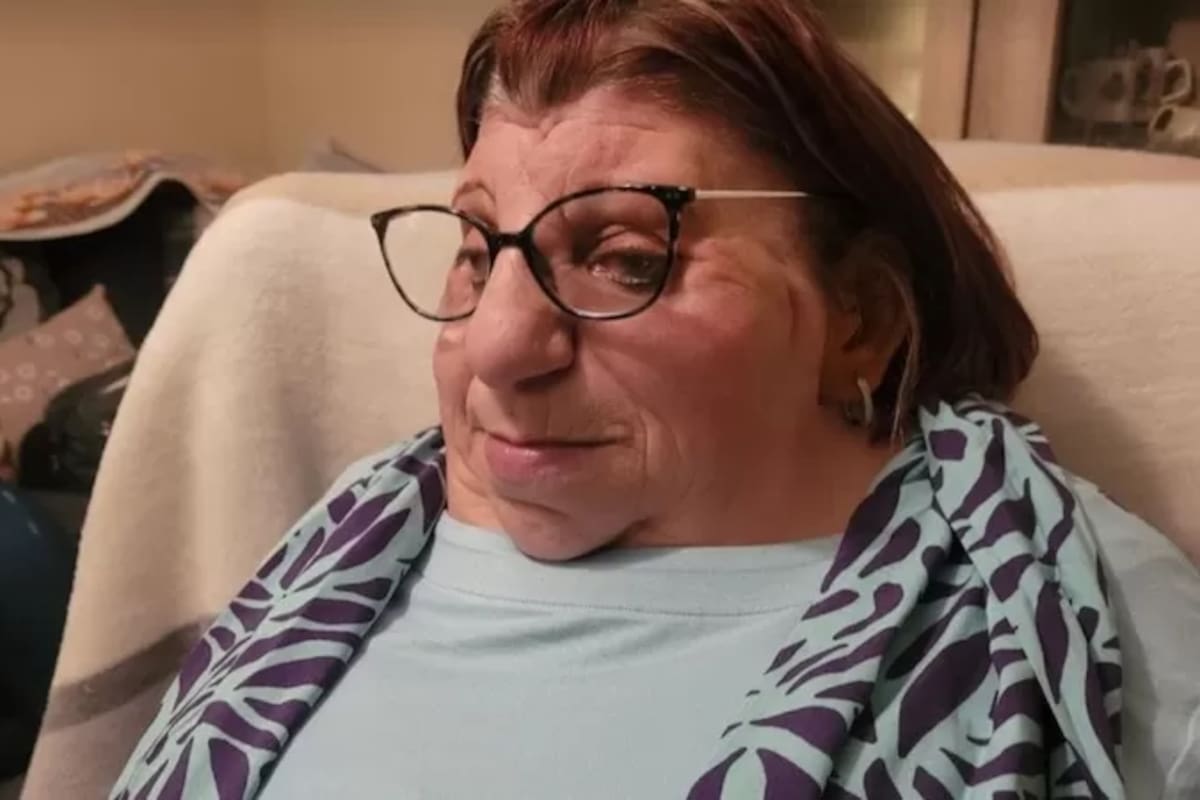 Janet Craven nació con un raro trastorno genético llamado síndrome de Treacher Collins