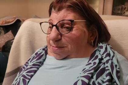 Janet Craven nació con un raro trastorno genético llamado síndrome de Treacher Collins