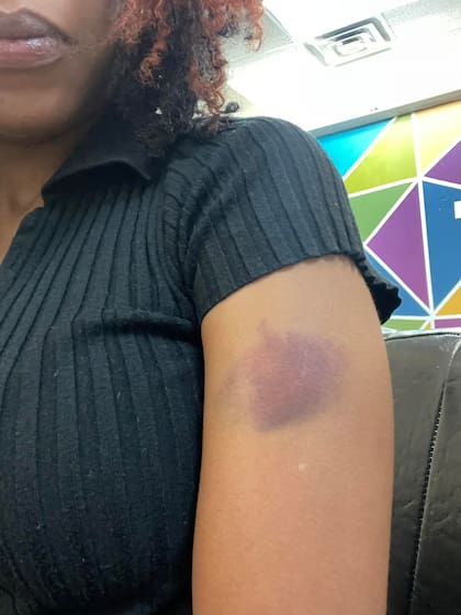Janine mostró los moretones que tuvo tras el percance con el juego