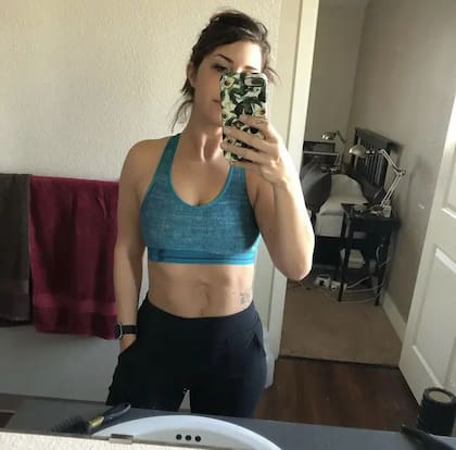 Jess Kaufman nació con onfalocele, un malformación genética que afecta a uno entre 4200 bebés