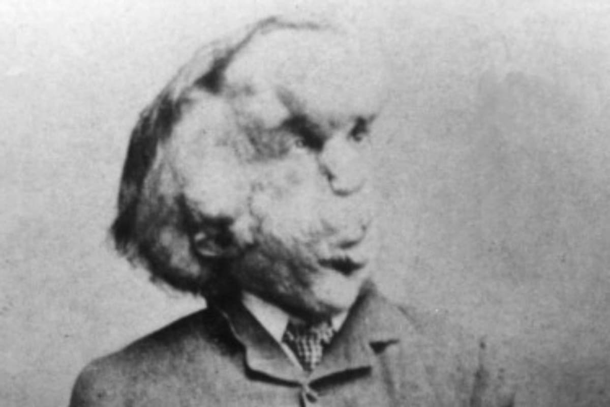Joseph Merrick, el hombre elefante, vivió solo 27 años en la segunda mitad del siglo XIX, en la Inglaterra victoriana