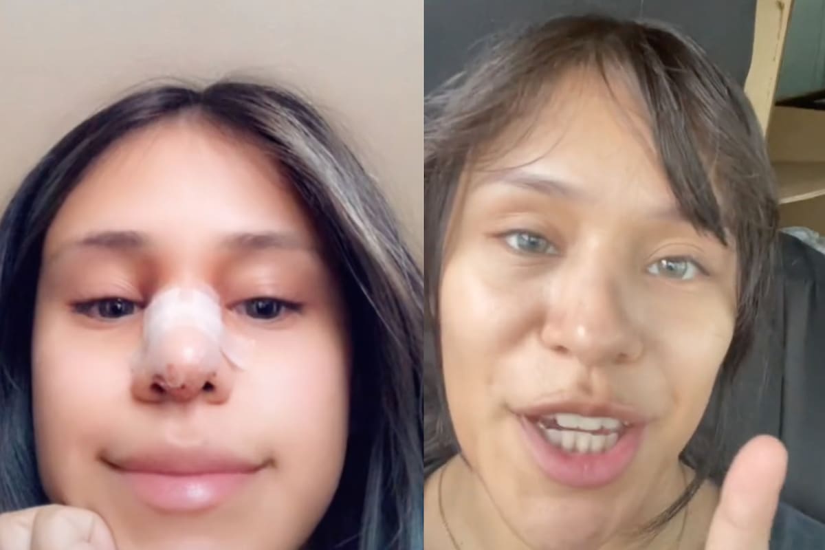 Joven obliga a su novio infiel a pagarle la cirugía de nariz