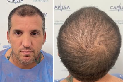 Juan Reverdito tomó por sorpresa a más de uno con su tratamiento capilar