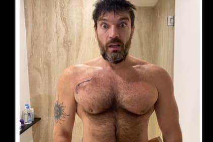 Julián Gil muestra la cicatriz que le quedó en el pecho por el cáncer de piel