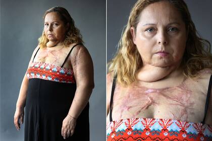 Karina Abregú sufrió un intento de femicidio: Gustavo Javier Albornoz la roció con alcohol y la prendió fuego.