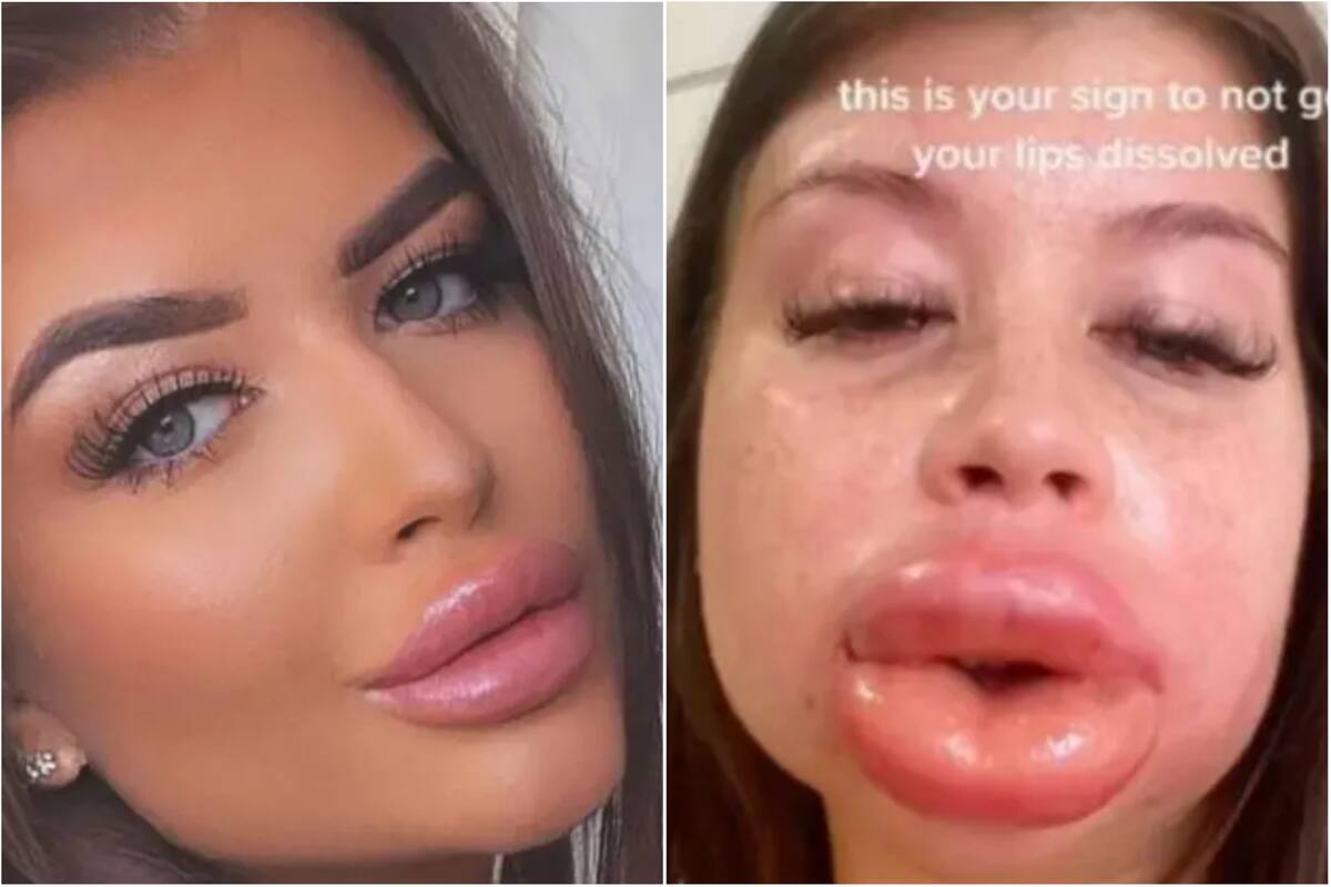 Karli Gardner mostró en TikTok cómo su cara y labios se hincharon por una alergia (Foto:Captura de Instagram)