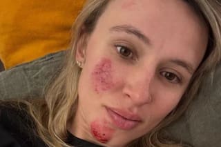 La ciclista ganadora del Tour de Francia mostró sus heridas tras perder el control y chocar con un guardarrail