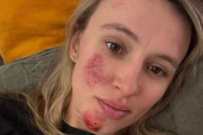 Kasia Niewiadoma tras su accidente durante una carrera en Italia
