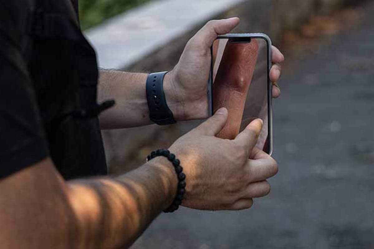 Kyle Planck relató la dura experiencia de contagiarse viruela del mono