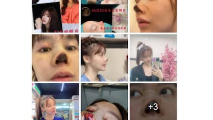 La actriz china Gao Liu compartió el resultado de la operación en sus redes sociales, causando estupor en sus seguidores