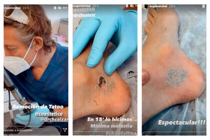 La actriz y conductora documentó cómo fue la primera sesión de remoción de un tatuaje en un centro de estética