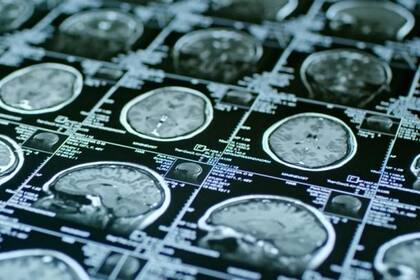 La acumulación de líquido en cavidades cerebrales por causas que la ciencia aún desconoce puede generar demencia potencialmente reversible en los adultos mayores