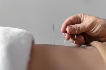 La acupuntura es una técnica milenaria que puede ayudar al cuerpo a relajarse