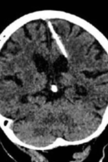 La aguja quedó incrustada en el cerebro desde que la mujer, que hoy tiene 80 años, era una beba, pero aparentemente no provocó lesiones ni consecuencias