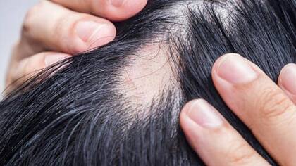La alopecia es más común en hombres
Foto: iStock