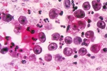 La ameba entra al organismo por la nariz y de allí migra hacia el cerebro