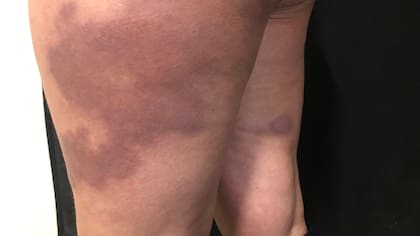 La aparición de manchas en la piel de distintas formas suele ser la primera señal de alerta de la lepra