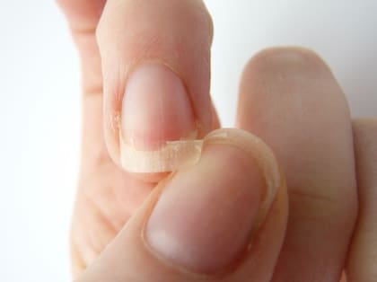 La aparición uñas quebradizas también es señal de que falta hierro