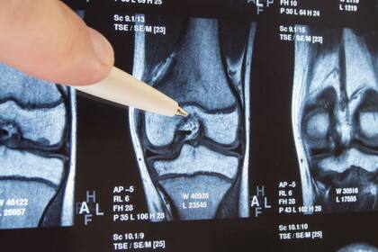 La artrosis afecta a 300 millones de personas en todo el mundo