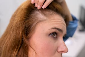 La caída de pelo puede afectar tanto a varones como mujeres (Foto: Freepik)