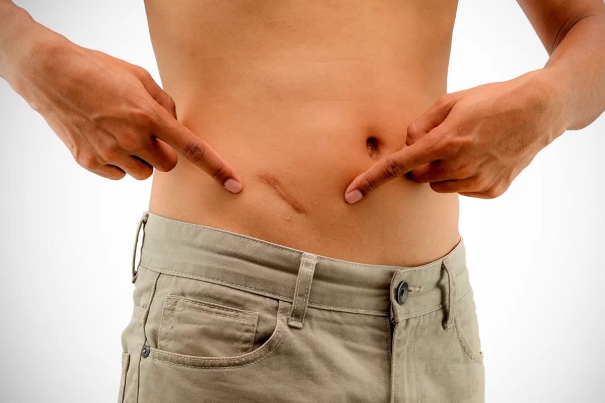 La cicatriz que deja la cirugía para extirpar el apéndice del cuerpo humano